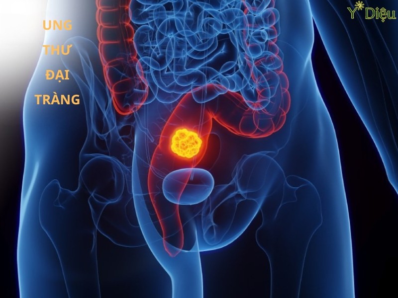 Ung Thư Đại Tràng: Phương Pháp Điều Trị Và Quản Lý Bệnh